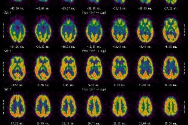 cerebro